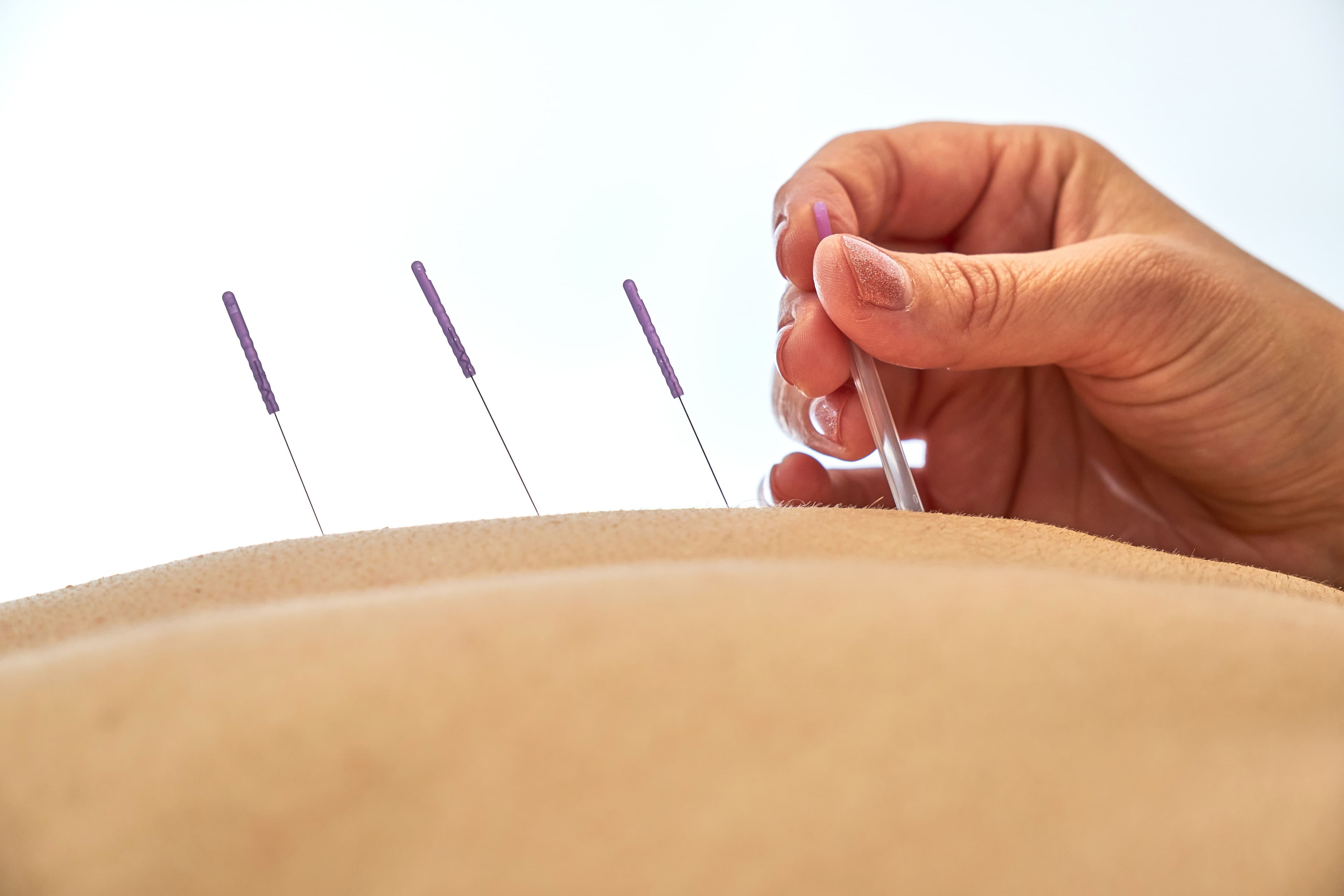 dry needling at podium theraipes